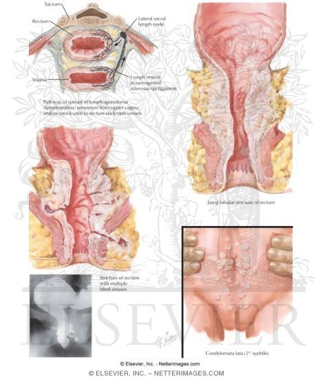 Watermarked preview of labeled image: Proctologic Conditions V - Lymphogranuloma Venereum and Syphilis