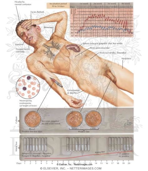 Watermarked preview of labeled image: Diagnosis of Typhoid Fever