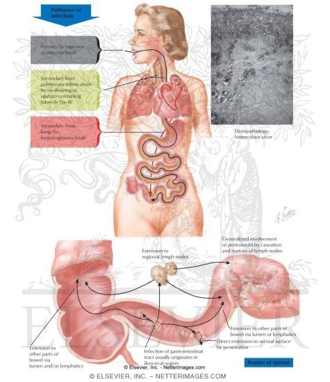 Intestinal Tuberculosis, Pathways of Infection, and Usual Location of Initial Lesion