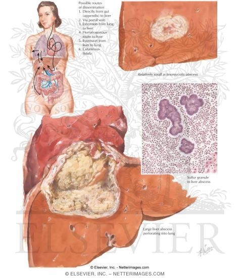 Actinomycosis