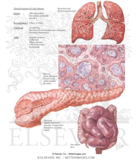 Watermarked preview of labeled image: Congenital Cystic Fibrosis