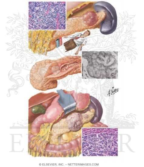 Islet Cell Tumors: Adenomas and Carcinoma