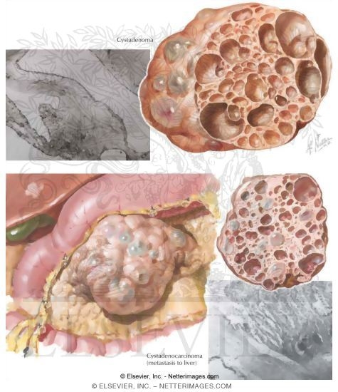 Watermarked preview of unlabeled image: Cystic Tumors: Cystadenoma and Cystadenocarcinoma