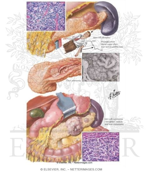 Watermarked preview of labeled image: Islet Cell Tumors: Adenomas and Carcinoma
