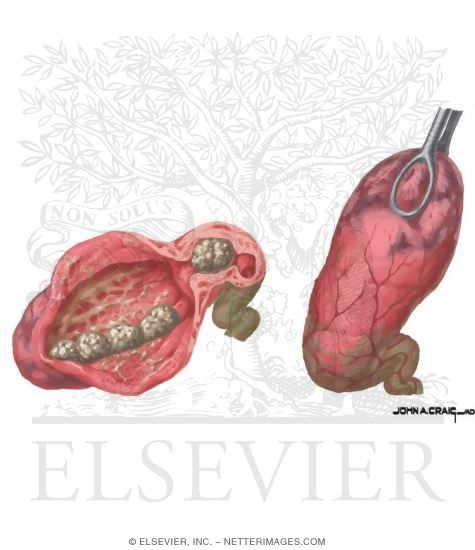 Acute Calculous Cholecystitis