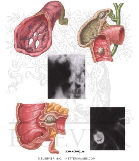 Complications of Cholecystitis