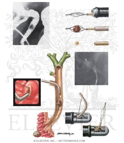 Watermarked preview of unlabeled image: Choledocholithiasis and  Cholangitis: Management of Stones