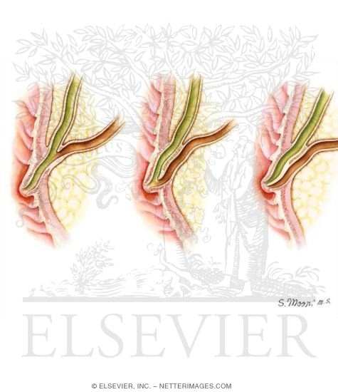 Sphincter of Oddi Dysfunction