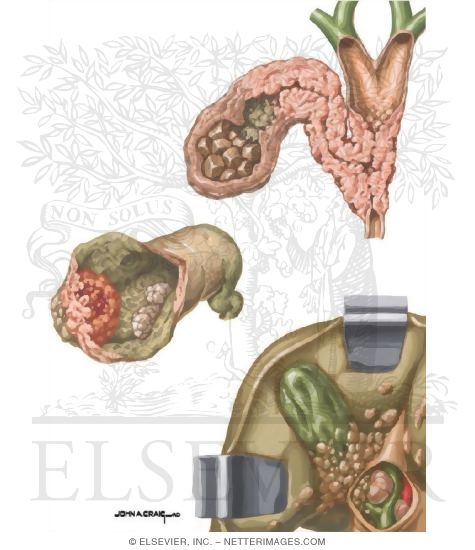 Gallbladder Cancer