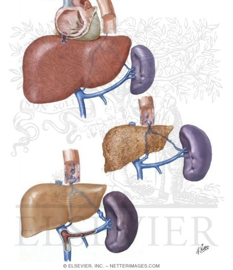 Causes of Portal Hypertension