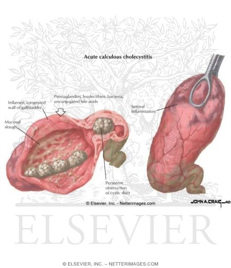 Watermarked preview of labeled image: Acute Calculous Cholecystitis