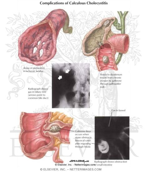 Complications of Cholecystitis