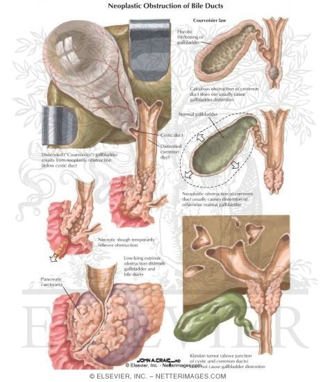 Watermarked preview of labeled image: Neoplastic Obstruction of the Bile Ducts
