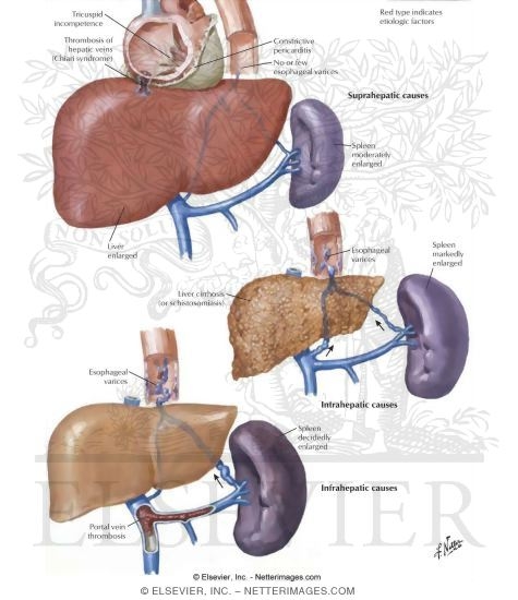 Watermarked preview of labeled image: Causes of Portal Hypertension