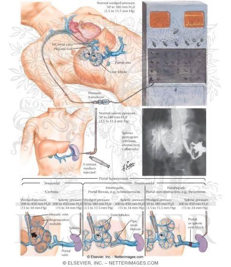 Watermarked preview of labeled image: Clinical Determination of Portal Hypertension