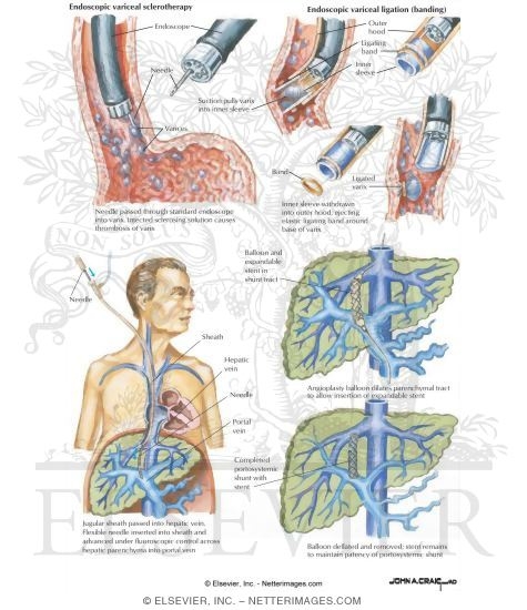 Watermarked preview of labeled image: Ligation Techniques In Variceal Bleeding