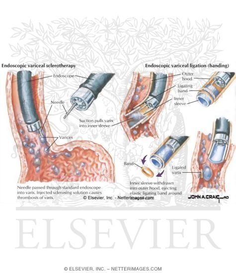 Variceal Bleeding: Ligation Techniques