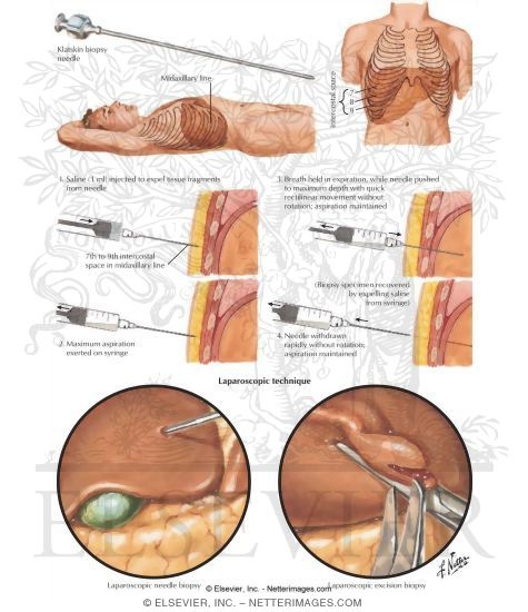 Liver Biopsy