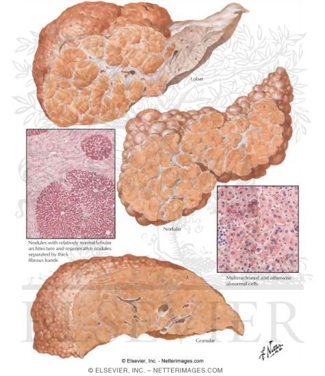 Postnecrotic Cirrhosis