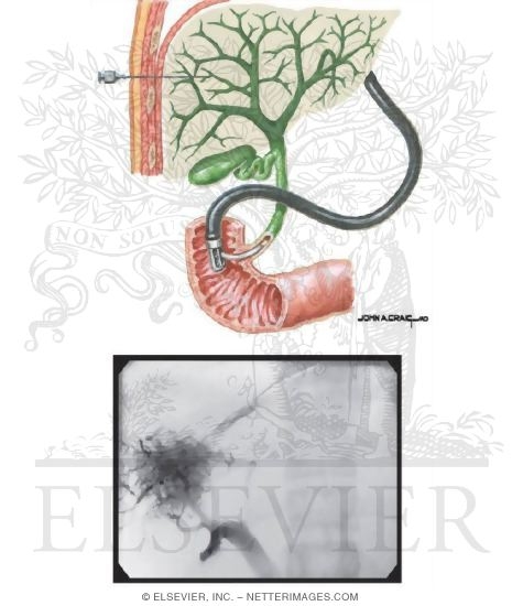 Watermarked preview of unlabeled image: Imaging Studies of the Liver: Cholangiography