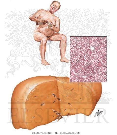 Alcoholic Liver Disease