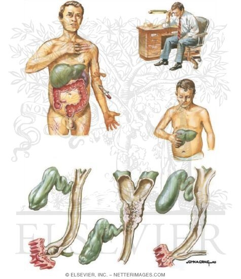 Watermarked preview of unlabeled image: Clinical Manifestations of Primary Sclerosing Cholangitis