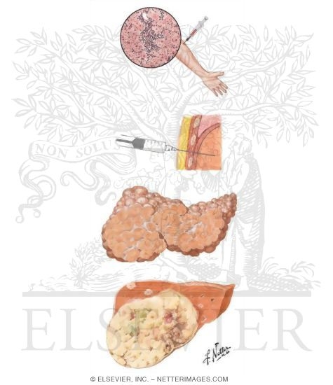 Clinical Picture of Hepatitis C Infection