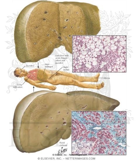 Watermarked preview of labeled image: Nutritional Liver Diseases
