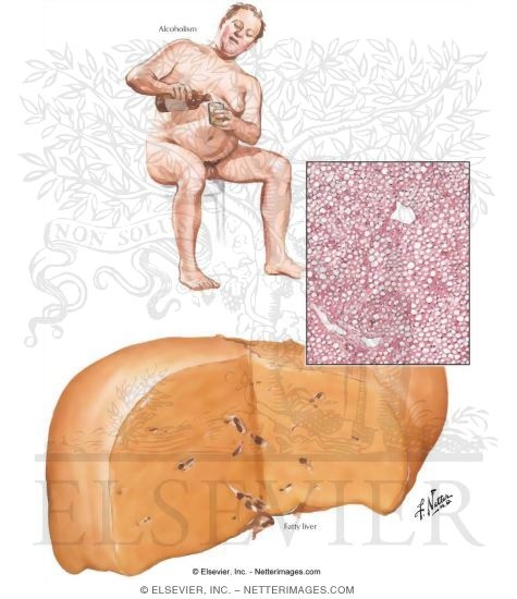 Alcoholic Liver Disease