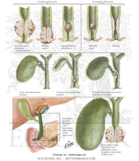 Extrahepatic Biliary Obstruction I - Mechanism