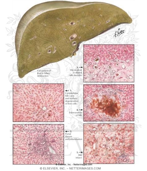 Extrahepatic Biliary Obstruction II - Stages