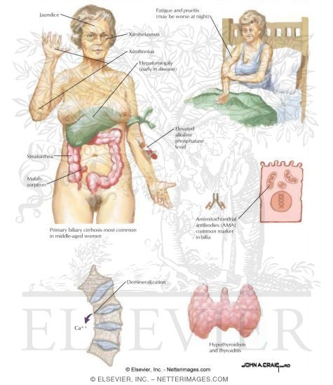 Watermarked preview of labeled image: Clinical Features of Primary Biliary Cirrhosis