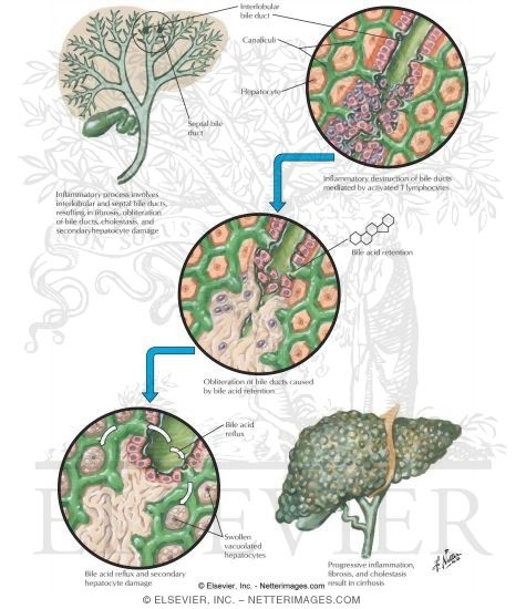 Watermarked preview of labeled image: Diseases of the Biliary Tract