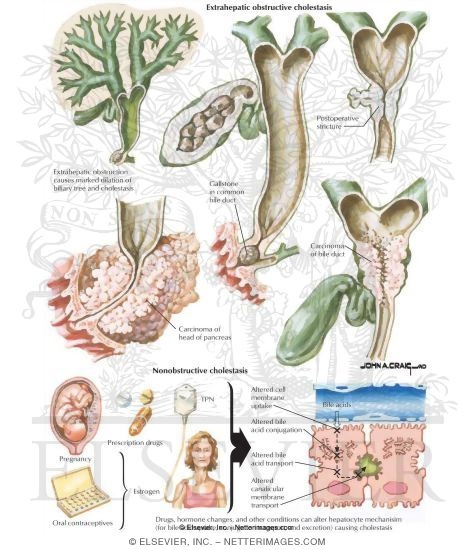 Primary Biliary Cirrhosis: Differential Diagnosis