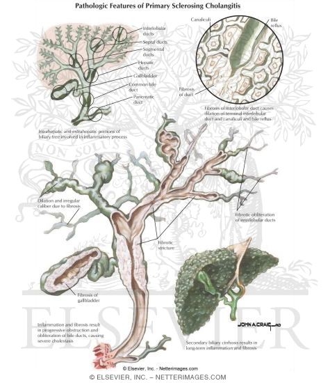 Diseases of the Biliary Tract