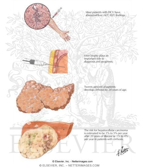 Clinical Picture of Hepatitis C Infection