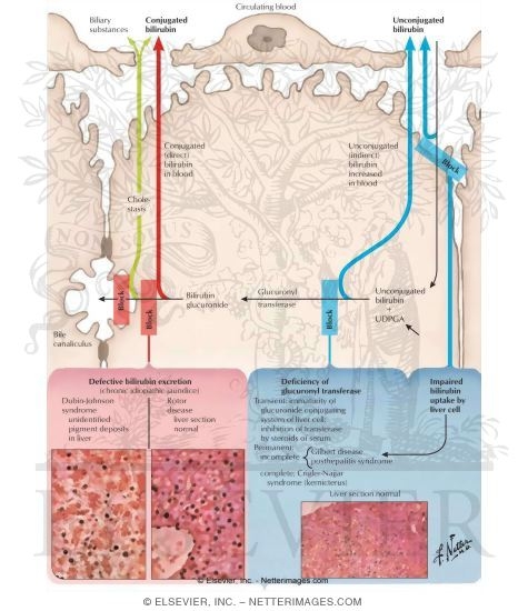 Watermarked preview of labeled image: Congenital and Familial Hyperbilirubinemias
