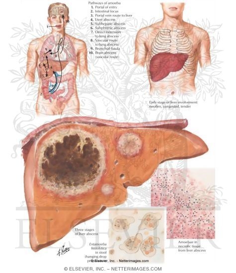 Amebiasis