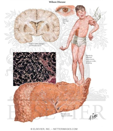 Illustration of Metabolic Injuries III - Wilson Disease from the Netter Collection