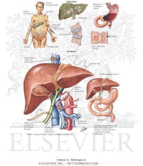 Watermarked preview of labeled image: Various Pathologies and Surgical Procedures Involving the Liver Including a Liver Transplant
