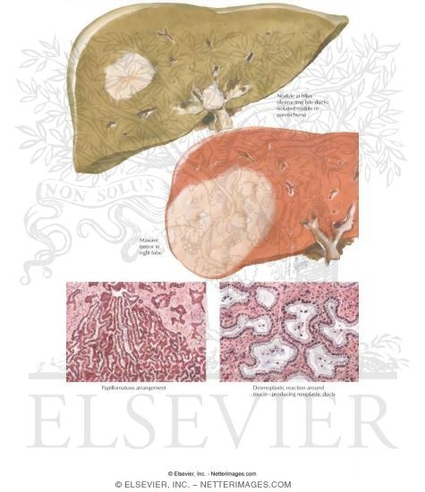 Watermarked preview of labeled image: Tumors IV - Bile Duct Carcinoma of Liver