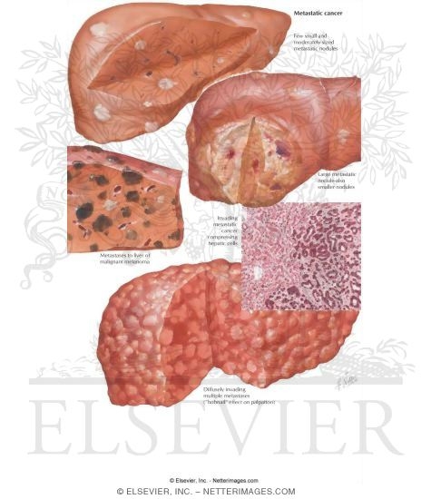 Watermarked preview of labeled image: Tumors V - Secondary, Metastatic