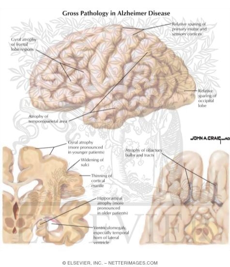 Watermarked preview of labeled image: Gross Pathology in Alzheimer's Disease