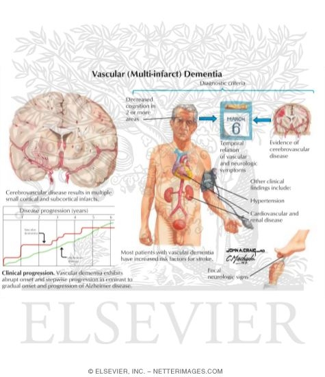 Watermarked preview of labeled image: Vascular (Multi-infarct) Dementia