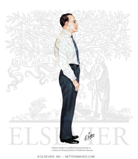 Watermarked preview of labeled image: Typical Posture of Patient With Progressive Supranuclear Palsy