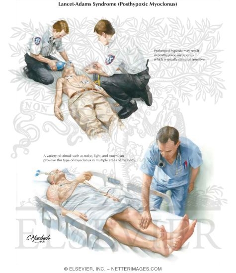 Watermarked preview of labeled image: Lancet-Adams Syndrome (Posthypoxic Myoclonus)