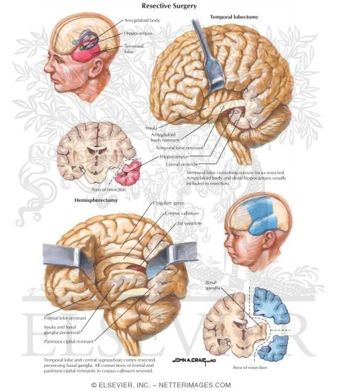 Resective Surgery