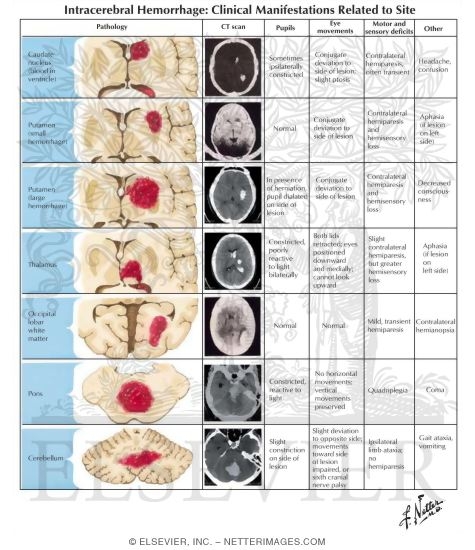 Intracerebral Hemorrhage: Clinical Manifestations Related to Site