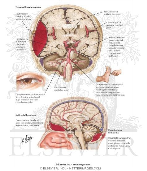 Epidural Hemorrhage