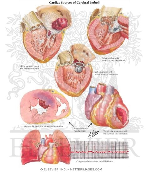 Watermarked preview of labeled image: Cardiac Sources of Cerebral Emboli